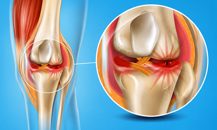 Knee Pain After Twisting Could Be a Sign of a Meniscus Tear